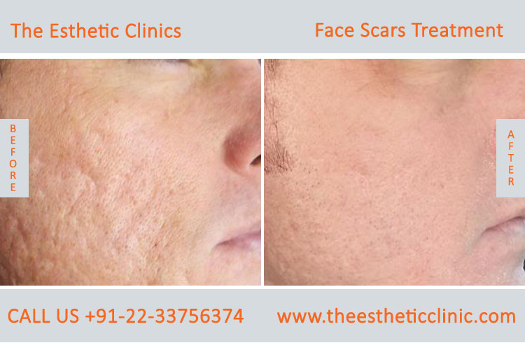 Face Scar Removal Laser Treatment before after photos in mumbai india (4)